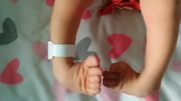 Mała Hania potrzebuje pomocy. Cierpi na rzadką chorobę stóp