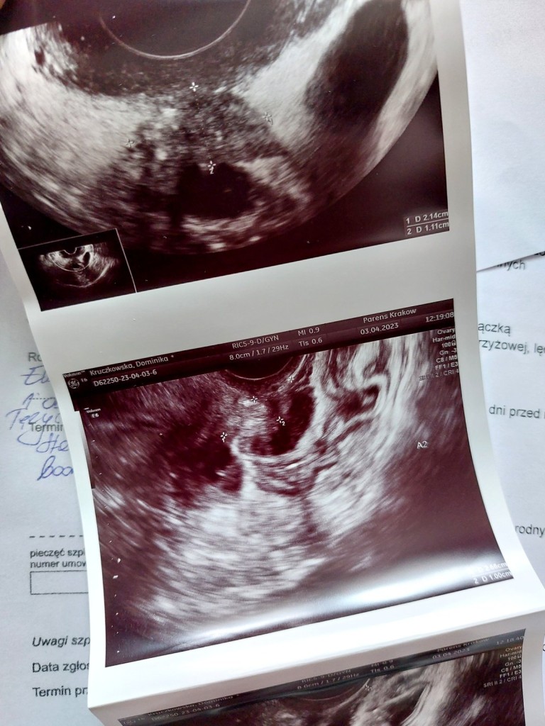 Walka z endometriozą. Szansą na normalne życie może być operacja