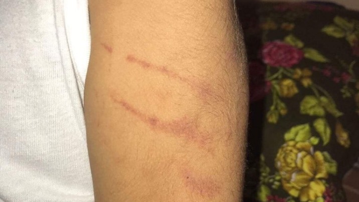 Z przedszkola z siniakami? Matka dziecka z autyzmem na policji&Acirc;&nbsp;