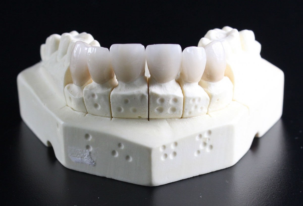Mity na temat implantów zębowych